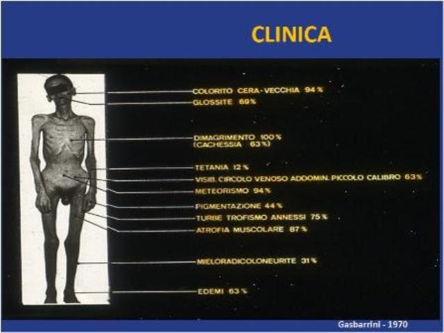  Fig.1- M.celiaca: grave malnutrizione per malassorbimento.